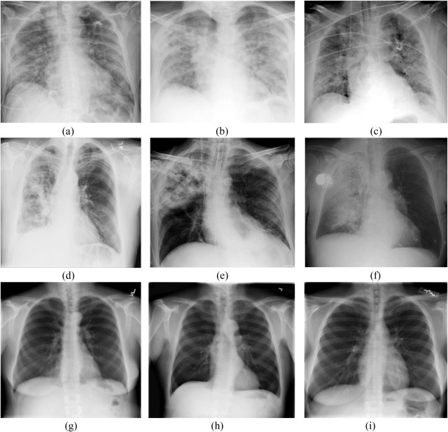 Ground-glass-opacity vs pneumonia vd healthy lungs